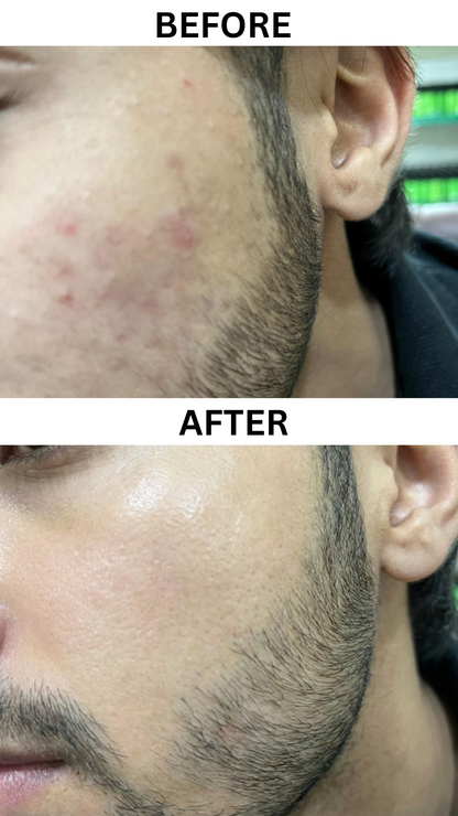 Clarix Homeo Anti-Acne & Whitening Soap